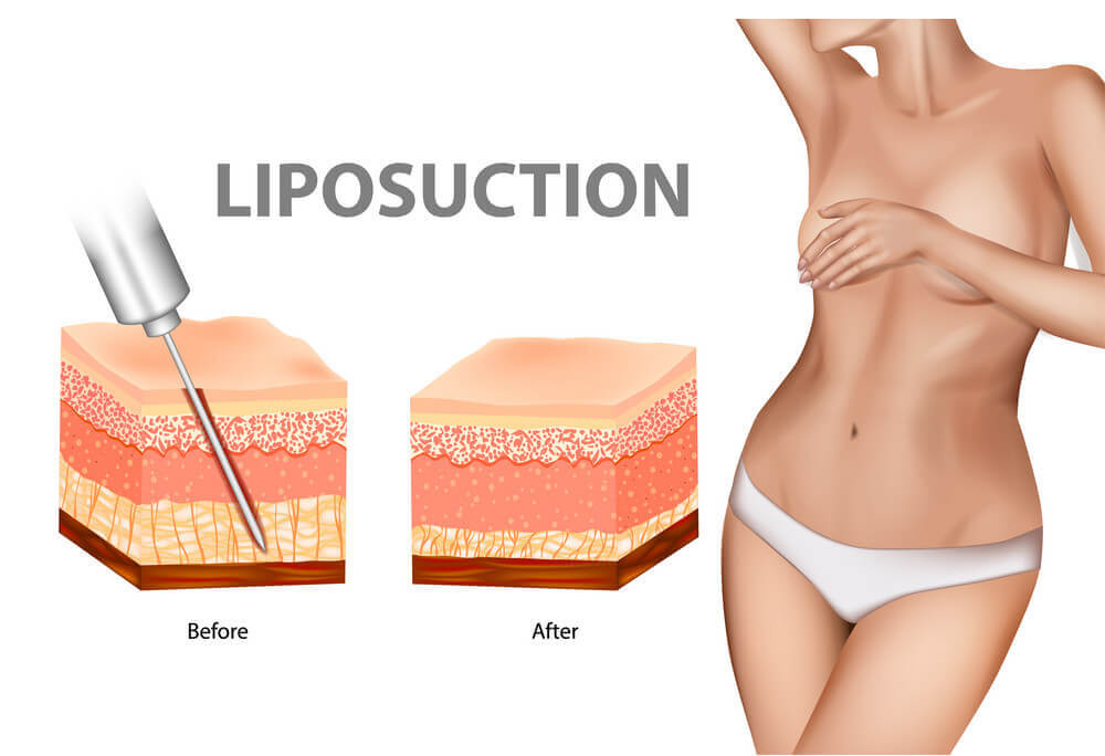 Liposuction ile yağ aldırma süreci