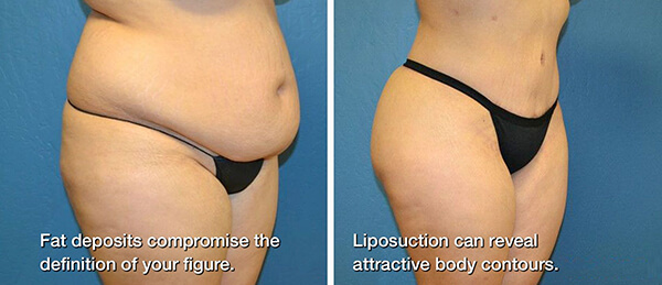 Liposuction kadın göbek yağ aldırma öncesi sonrası