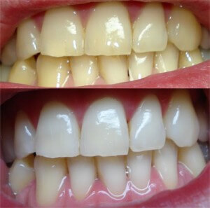 diş beyazlatma öncesi sonrası