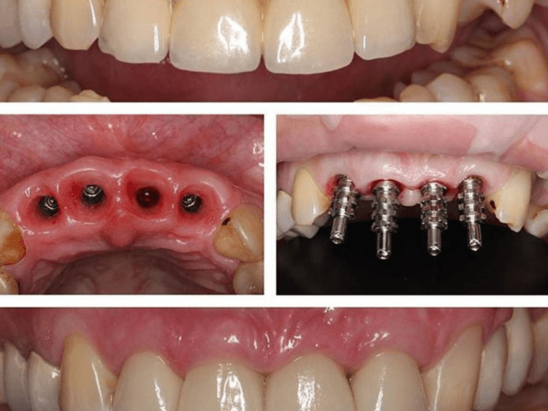 diş implantı nasıl yapılır