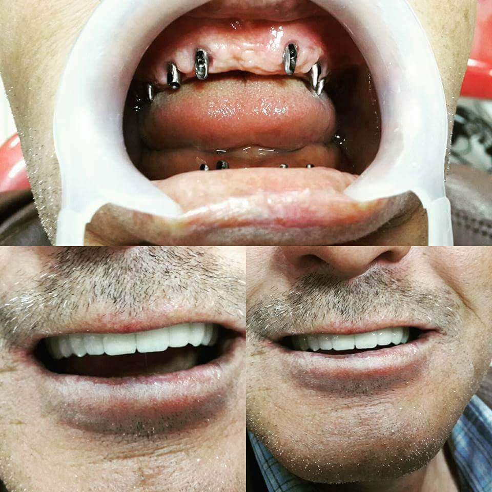 diş implantı sonrası