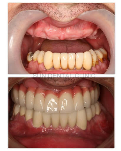 diş implantı öncesi sonrası