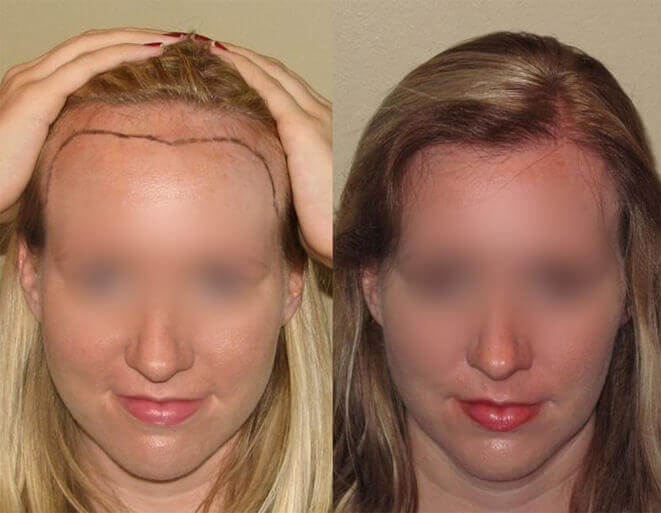 kadın saç ekimi sonuçları