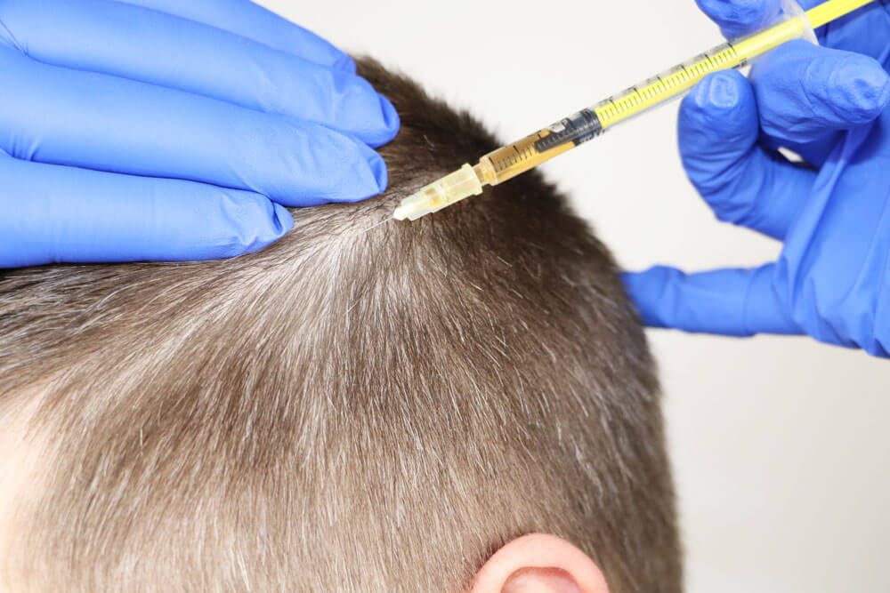 saç mezoterapisi nasıl yapılır