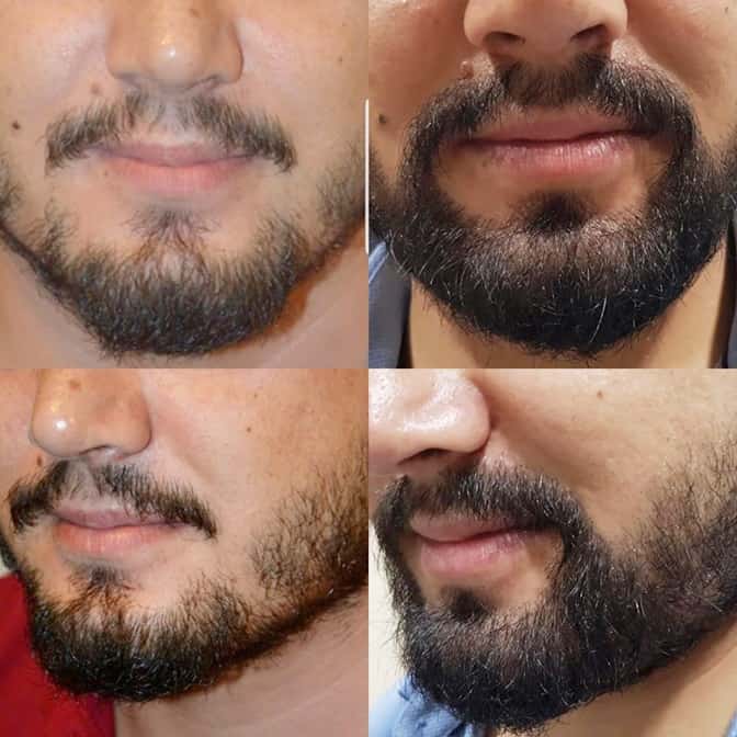 sakal ekimi sonuçları